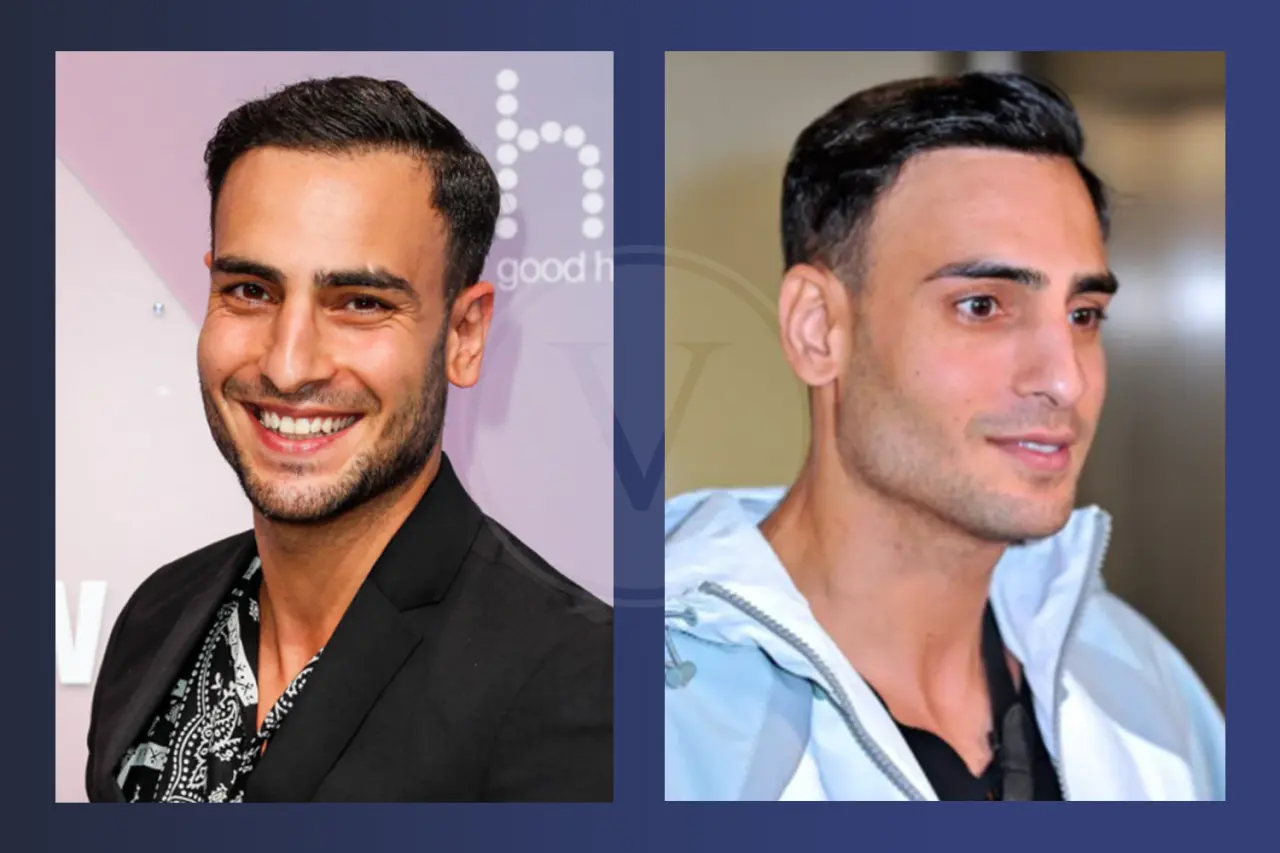 Timur Ülker Haare: Vorher und Nachher