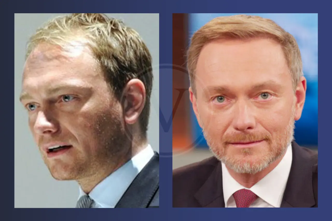 Promis mit Haartransplantation: Vorher - Nachher