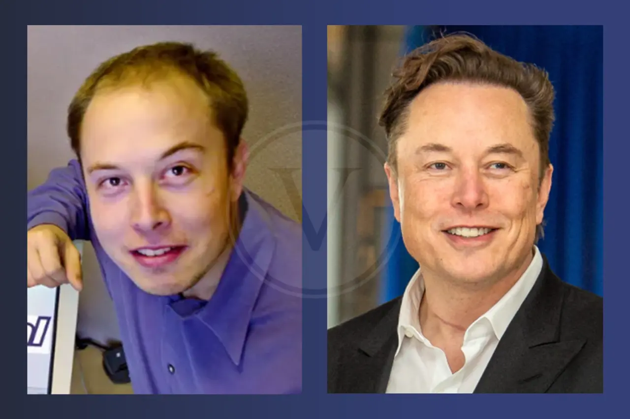 Promis mit Haartransplantation: Vorher - Nachher