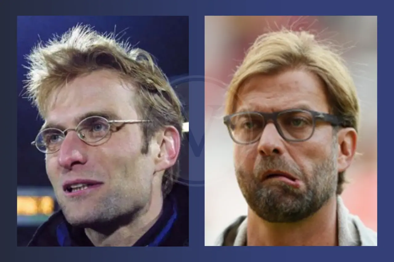 Promis mit Haartransplantation: Vorher - Nachher