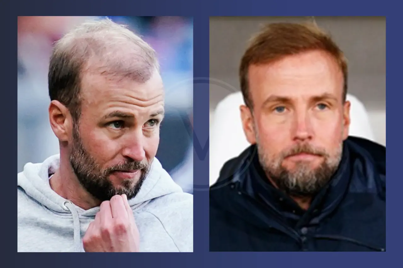 Promis mit Haartransplantation: Vorher - Nachher