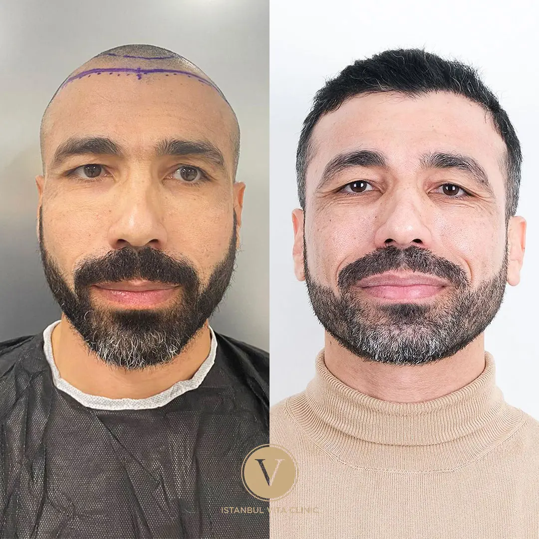 Beste Haartransplantation Türkei – Vorher Nachher Ergebnisse