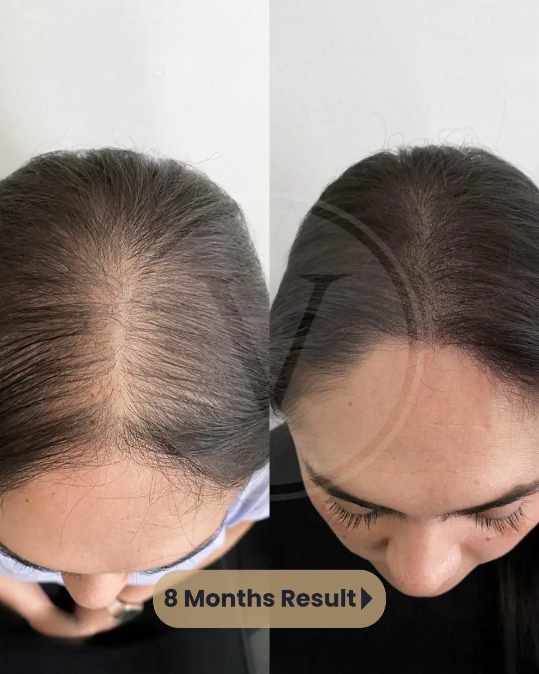 Beste Haartransplantation Türkei – Vorher Nachher Ergebnisse