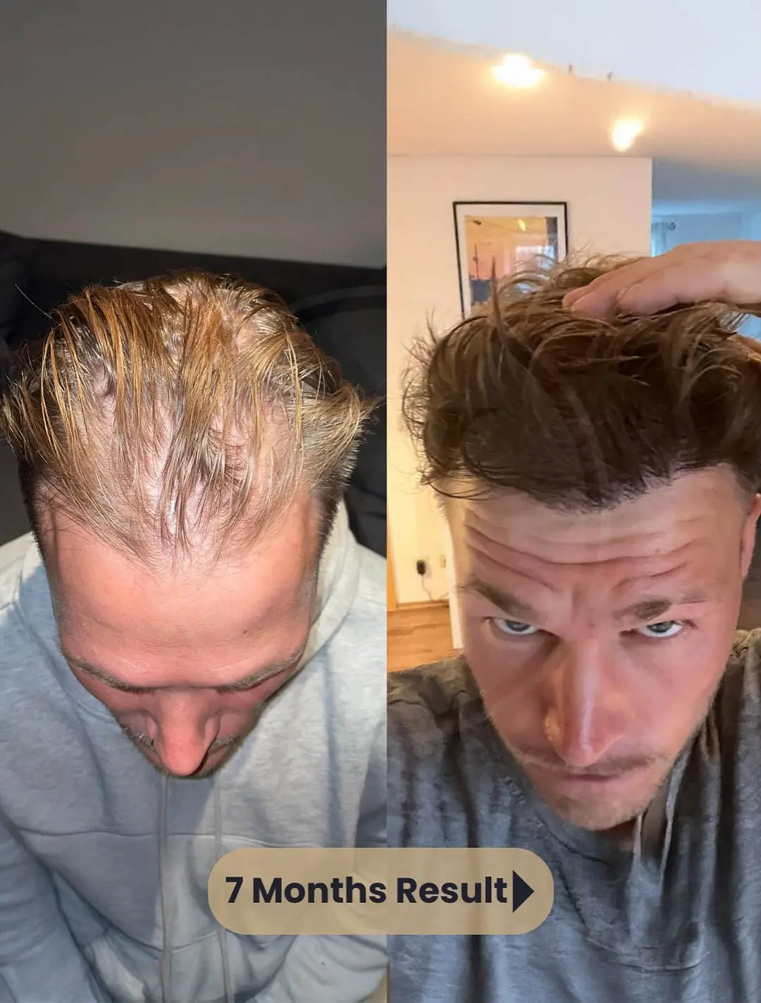 Beste Haartransplantation Türkei – Vorher Nachher Ergebnisse