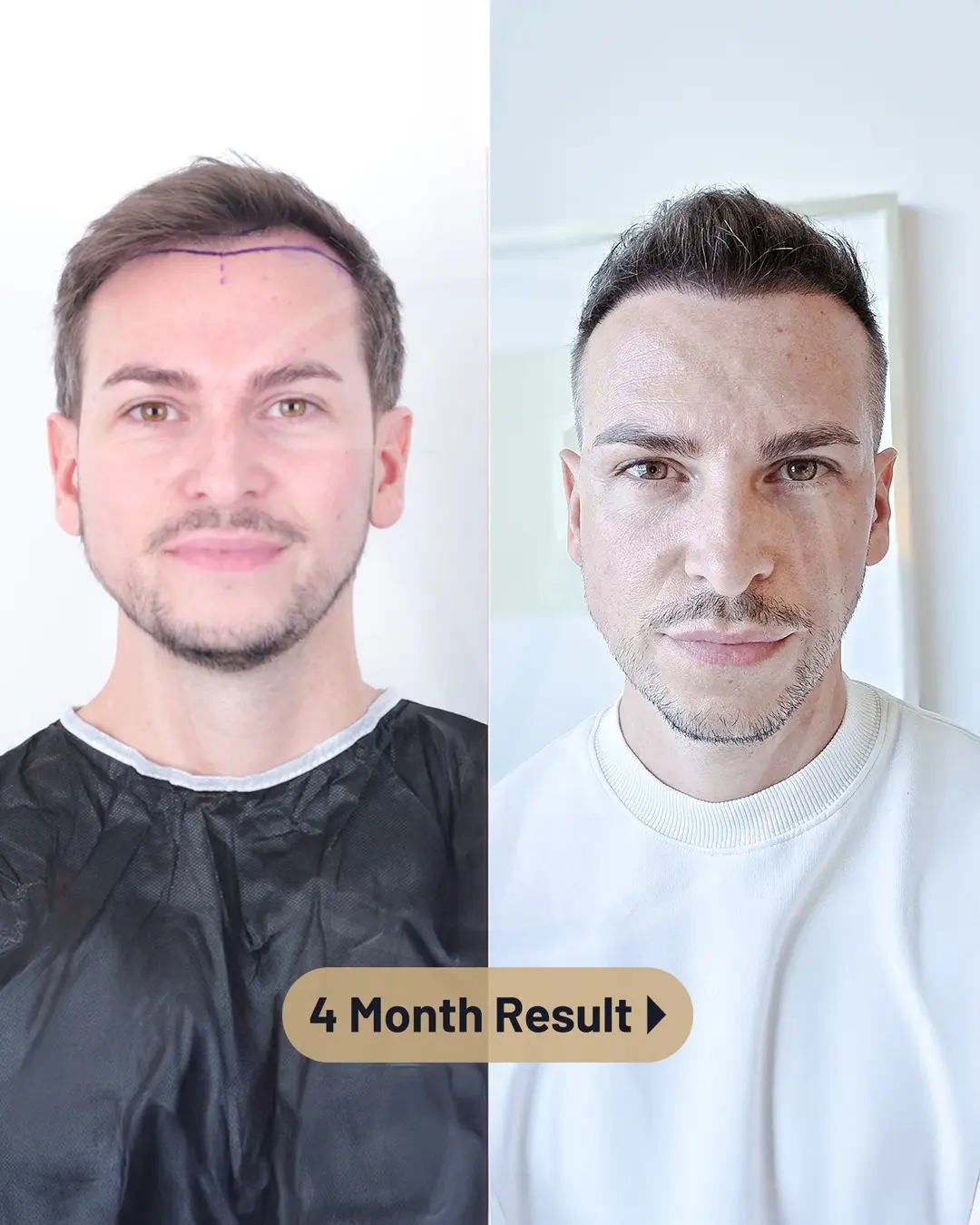 Beste Haartransplantation Türkei – Vorher Nachher Ergebnisse