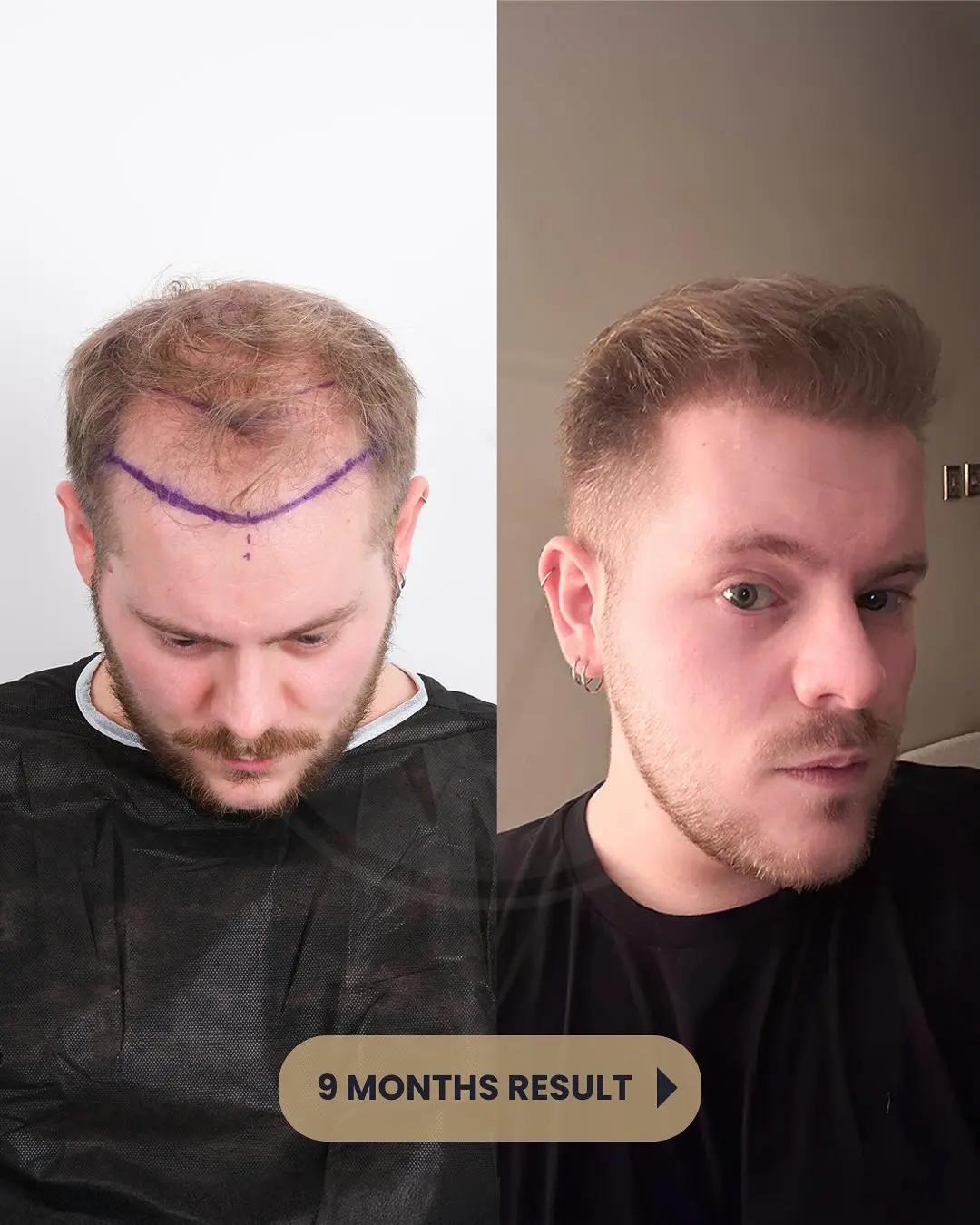 Beste Haartransplantation Türkei – Vorher Nachher Ergebnisse