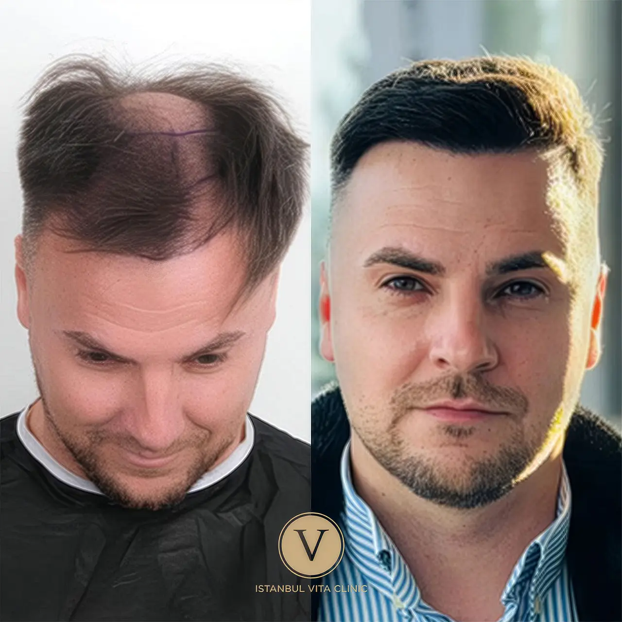 Beste Haartransplantation Türkei – Vorher Nachher Ergebnisse