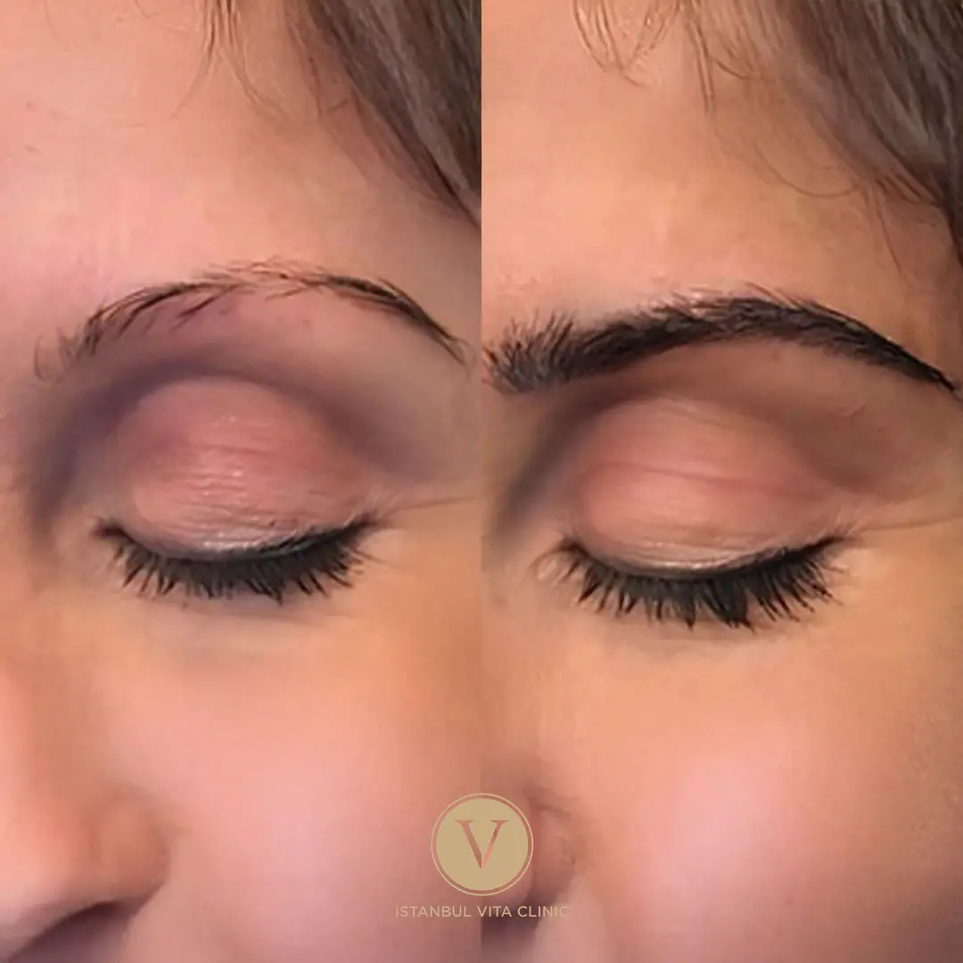 Beste Haartransplantation Türkei – Vorher Nachher Ergebnisse