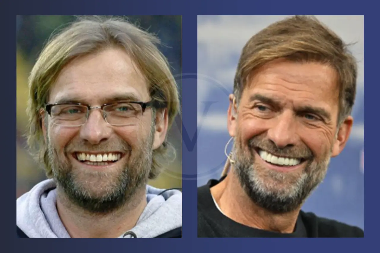 Jürgen Klopp Haare: Vorher und Nachher - Haartransplantation