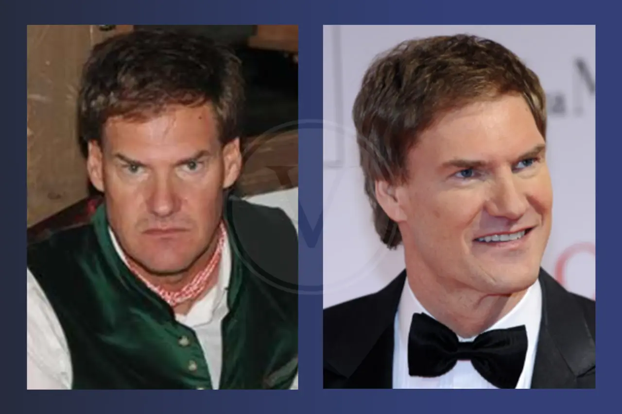 Carsten Maschmeyer Haare: Vorher und Nachher