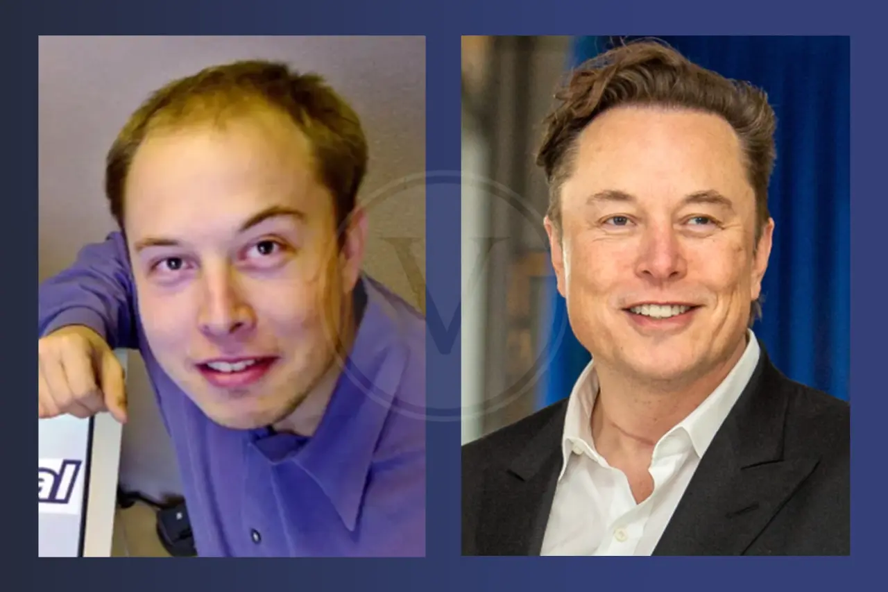 Elon Musk Haare Haare: Vorher & Nachher Haartransplantation