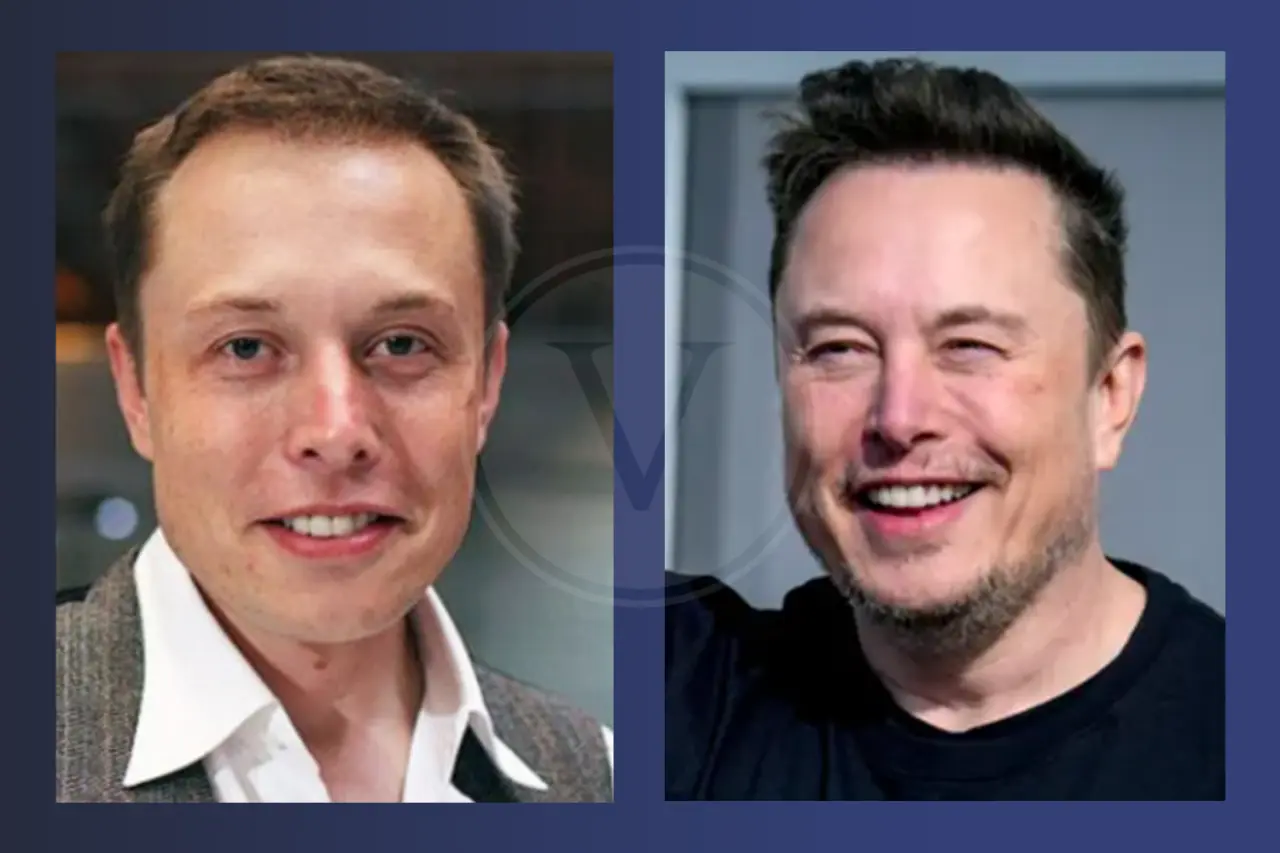 Elon Musk Haare Haare: Vorher & Nachher Haartransplantation