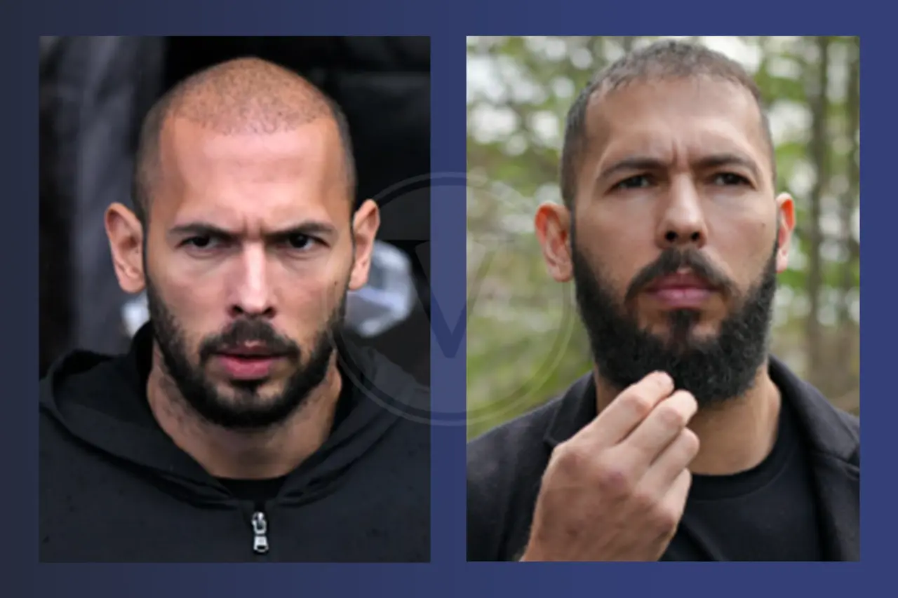 Andrew Tate Before and After Hair Transplant