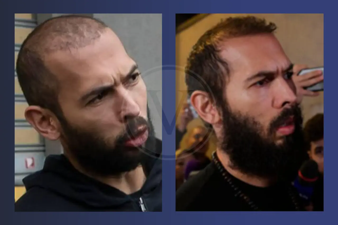 Andrew Tate Before and After Hair Transplant