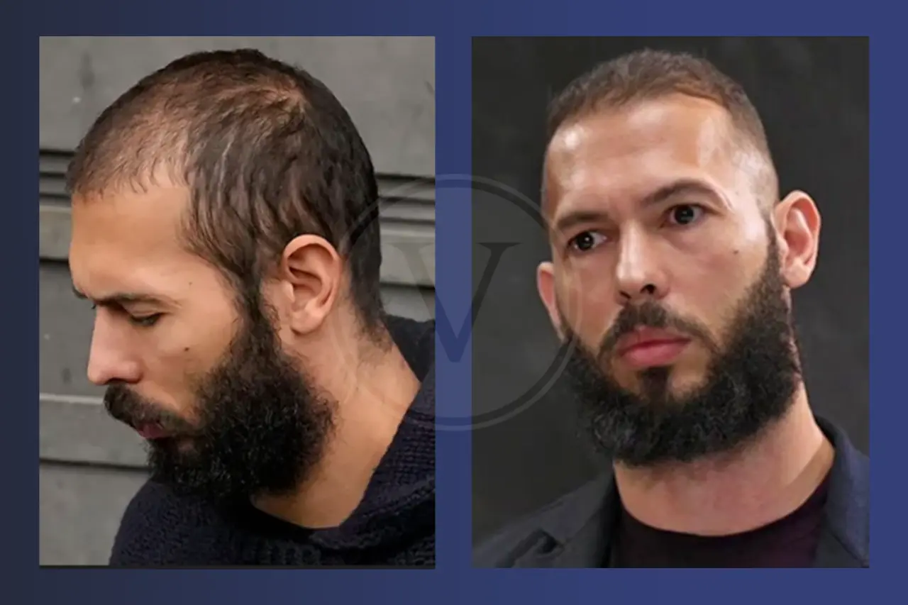 Andrew Tate Before and After Hair Transplant