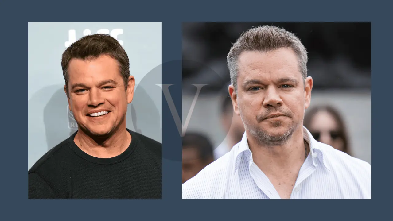 Matt Damon's Hair Transplant