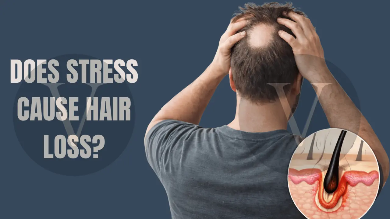 Does stress cause hair loss?