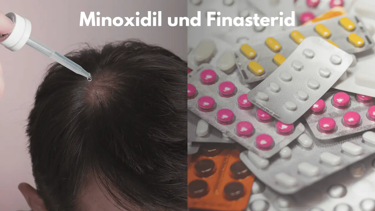 Minoxidil and Finasterid