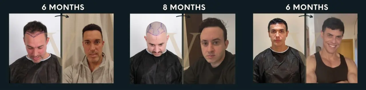Résultats avant et après de la greffe de cheveux DHI