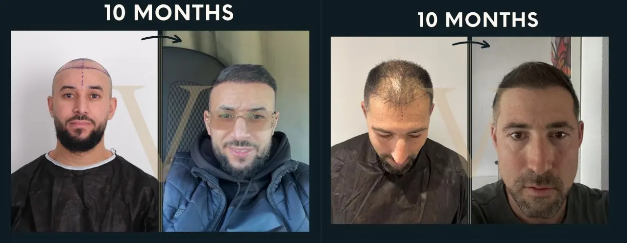 istanbul vita tdf hair transplant