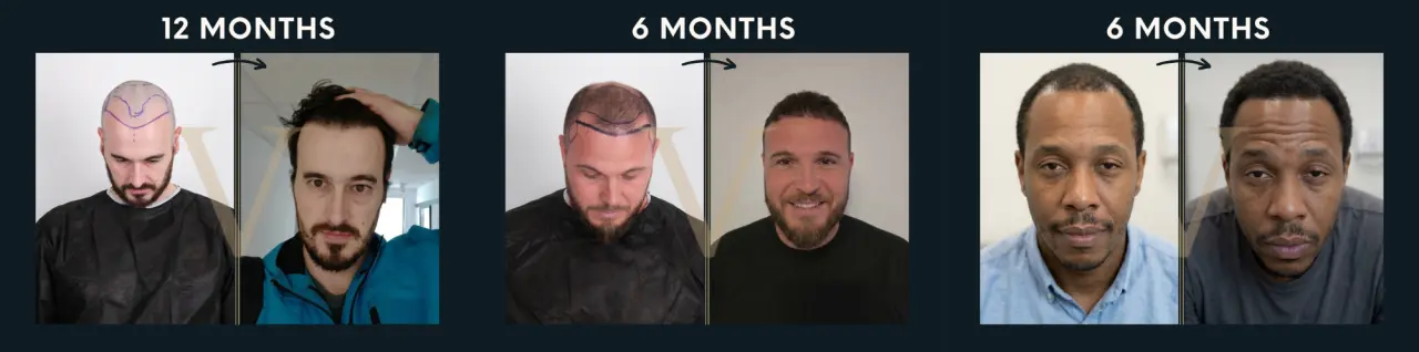 greffe de cheveux avant et après