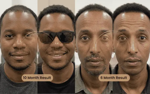 afro hair transplant before after