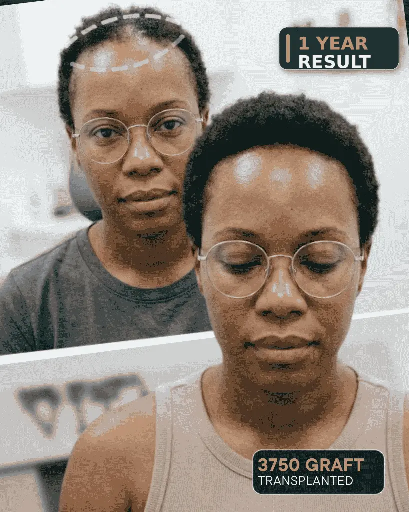 afro hair transplant for women