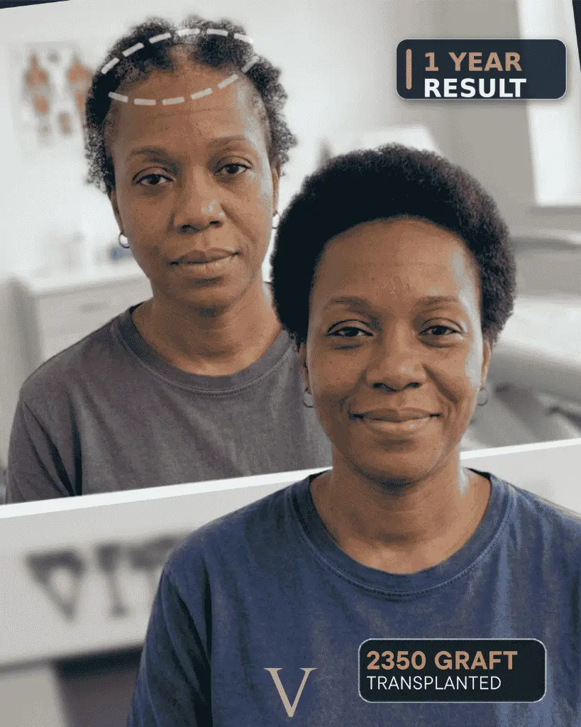 afro hair transplant for women in turkey