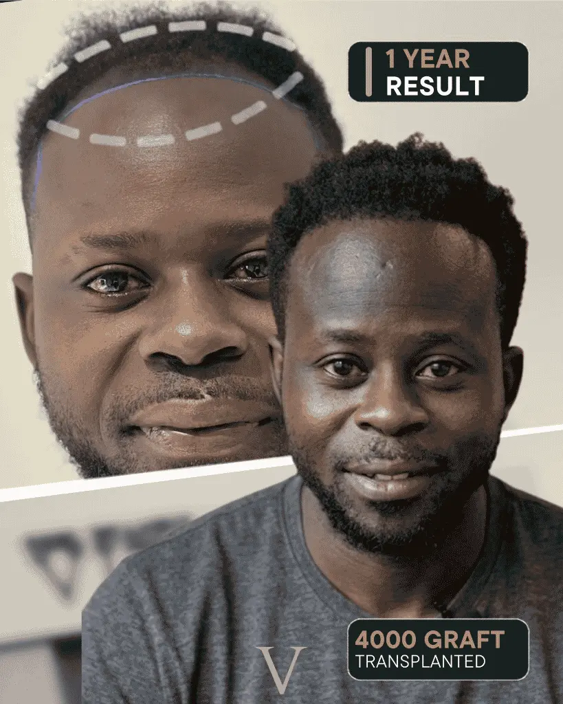 hair transplant for afro men