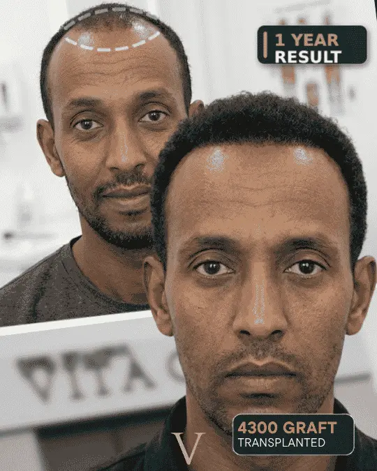 curly hair transplant before after