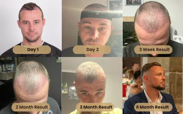 2000 grafts hair transplant
