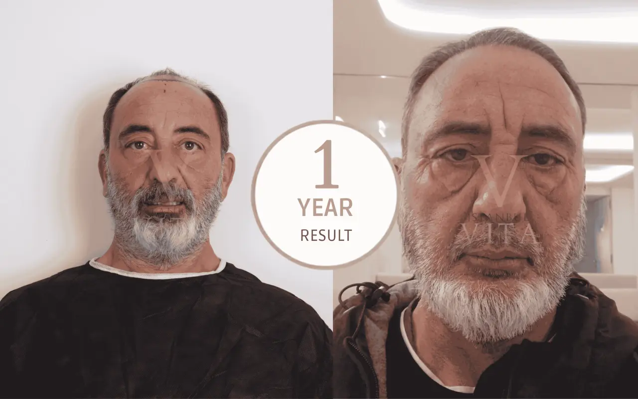 afro hair transplant 1 year result