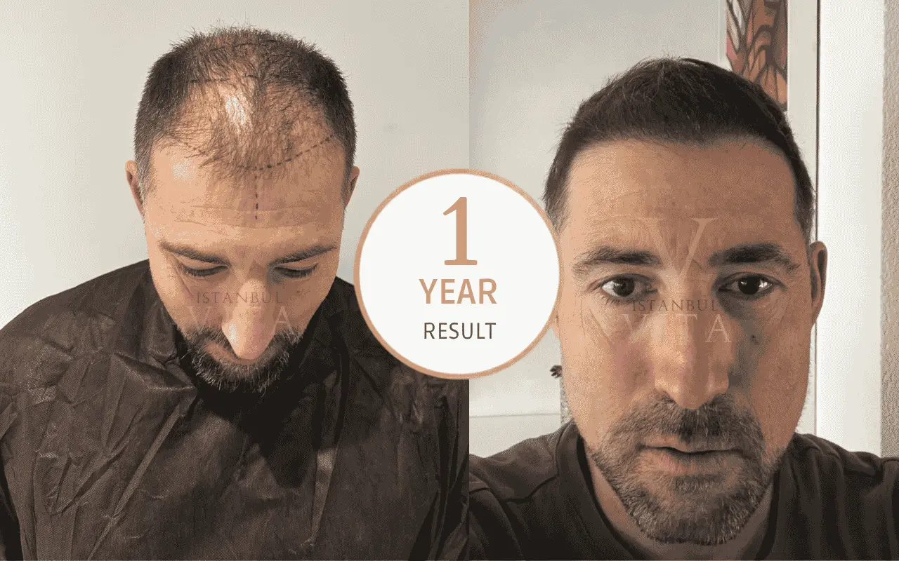 a man with the visible results of before and after hair transplant 
