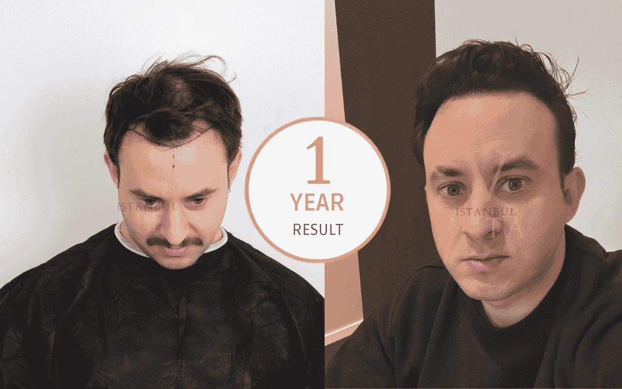 the person with the visible hair transplant before and after results 