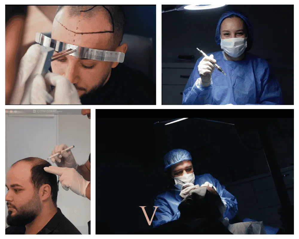 the doctor is performing the hair transplant on the different patients 