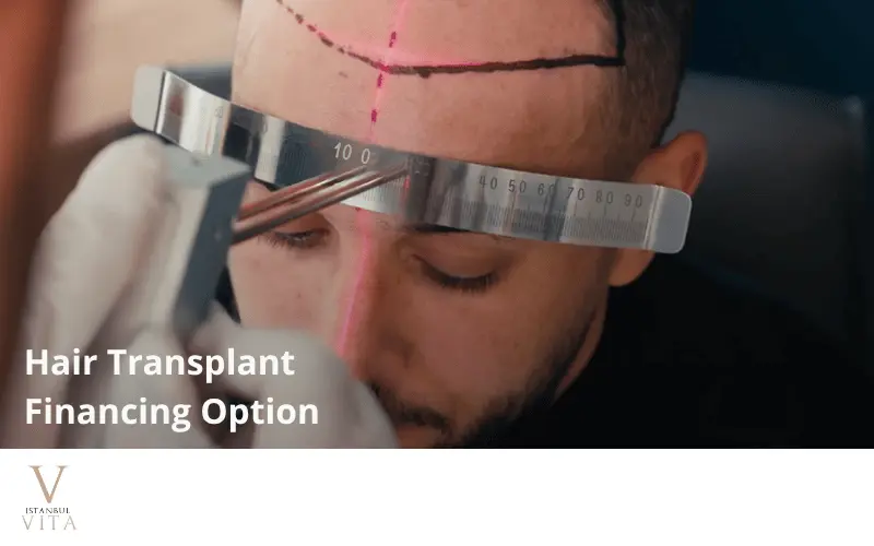 hair transplant financing options&costs guide