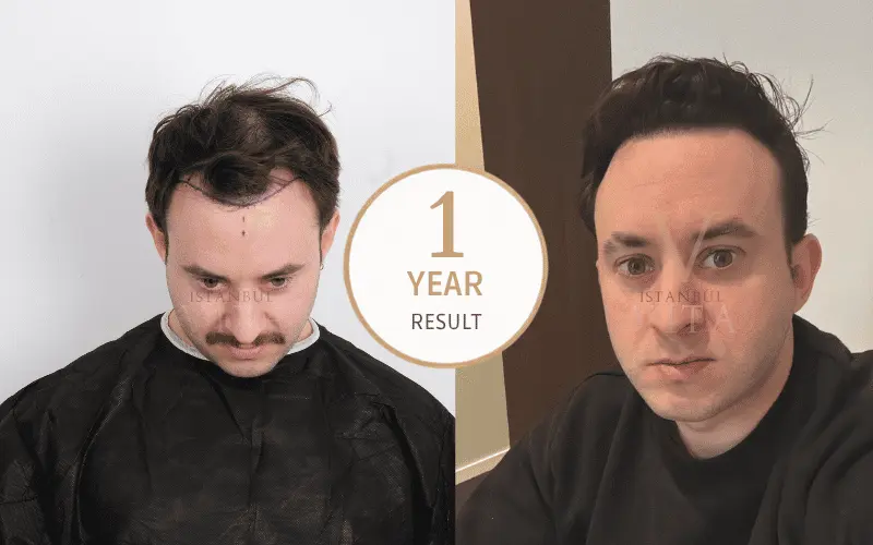 hairline Design 1 year result,