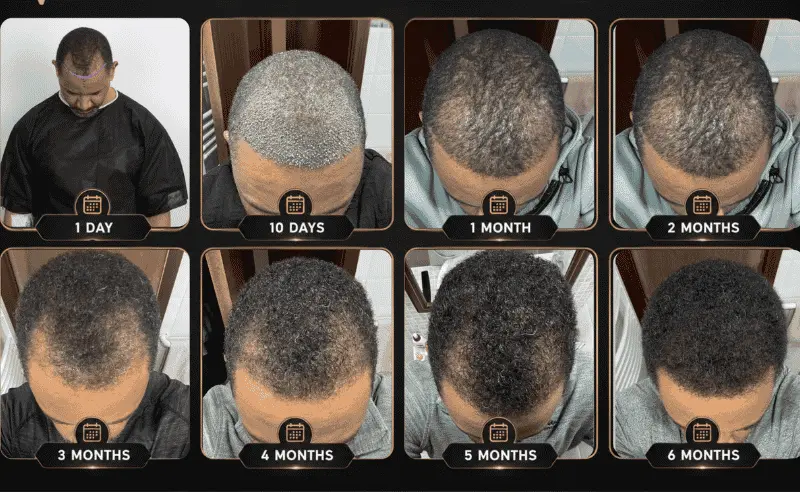 afro hair transplant before after
