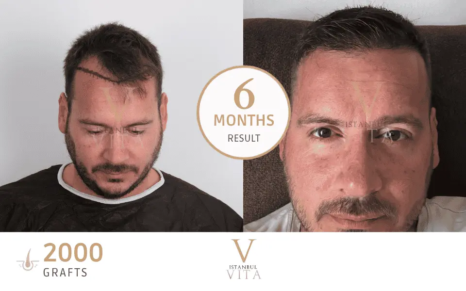 a man with 2000 grafts hair transplant before and after 