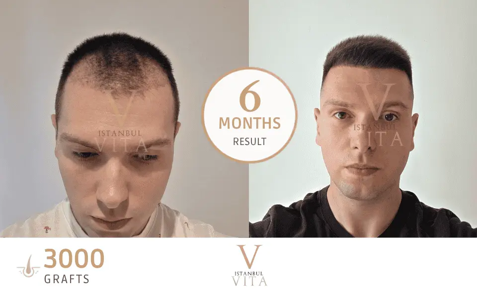 a man with 3000 grafts hair transplant before and after 