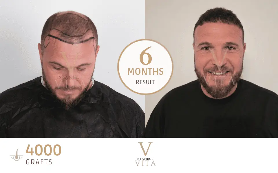a man with 6 months 4000 grafts transplant 