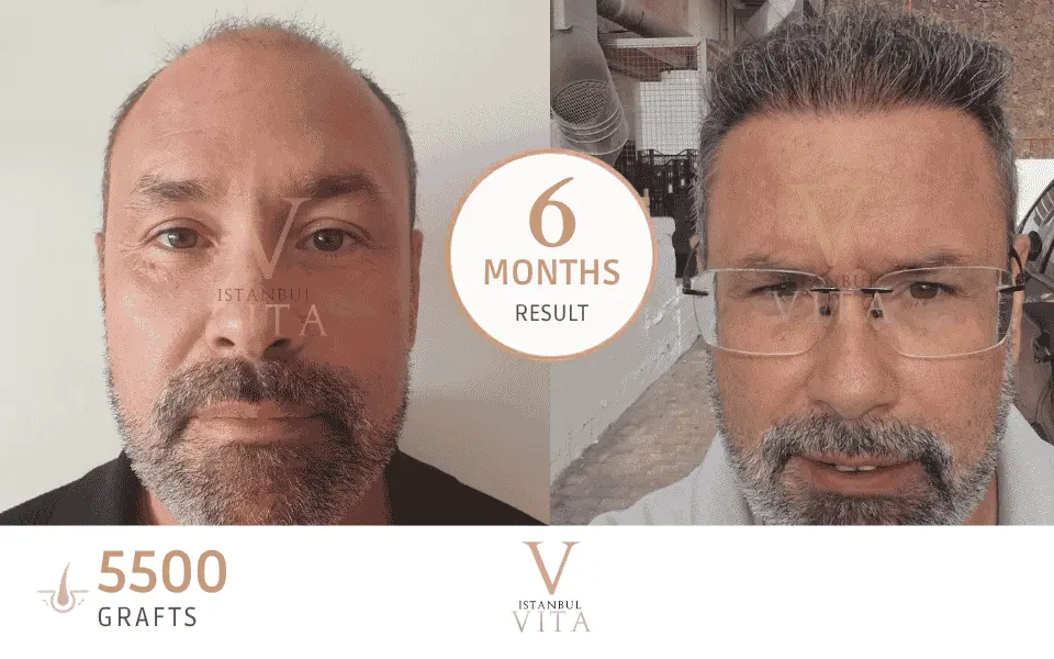 5500 grafts result after 6 months 