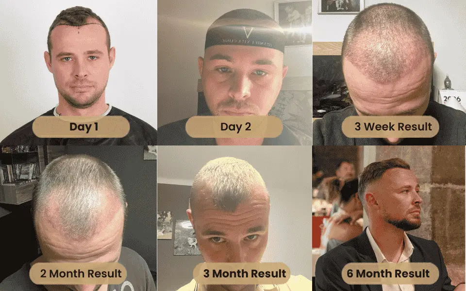 a man with a hair transplant recovery results by months 