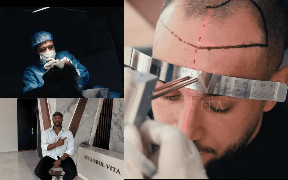 a dr performing hair transplant on patient