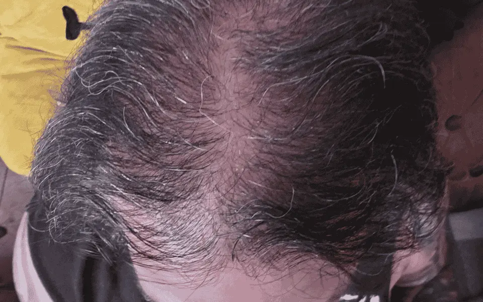 ingrown hair extraction