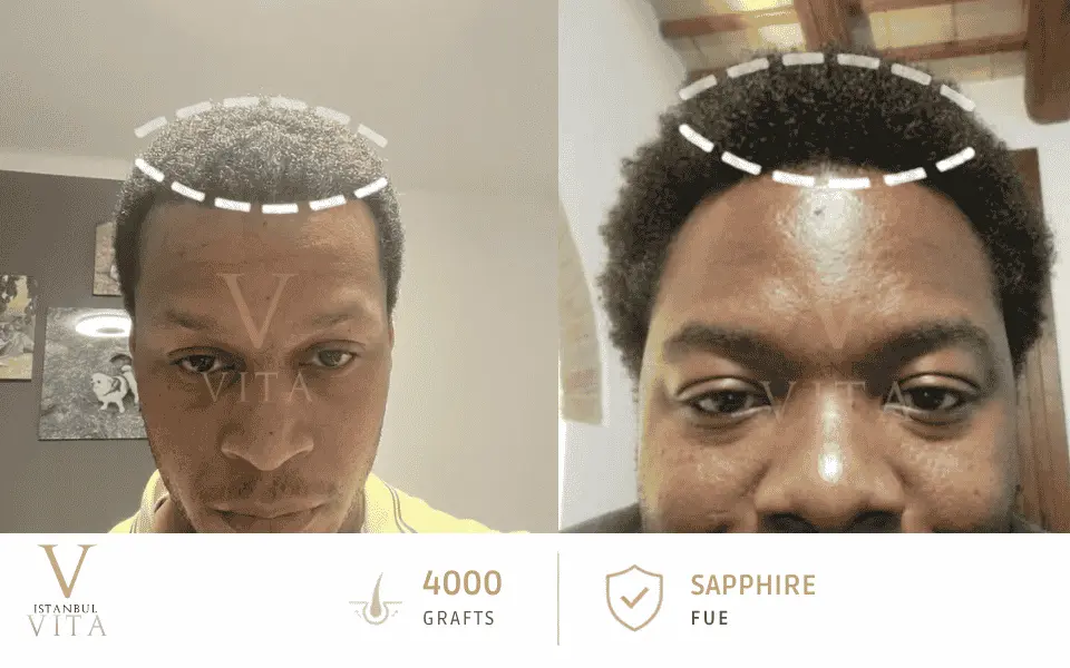 Best Hairline Design for Afro Hair