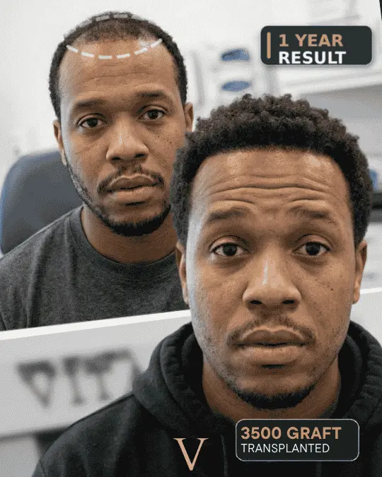 Afro Hair Transplant Before After