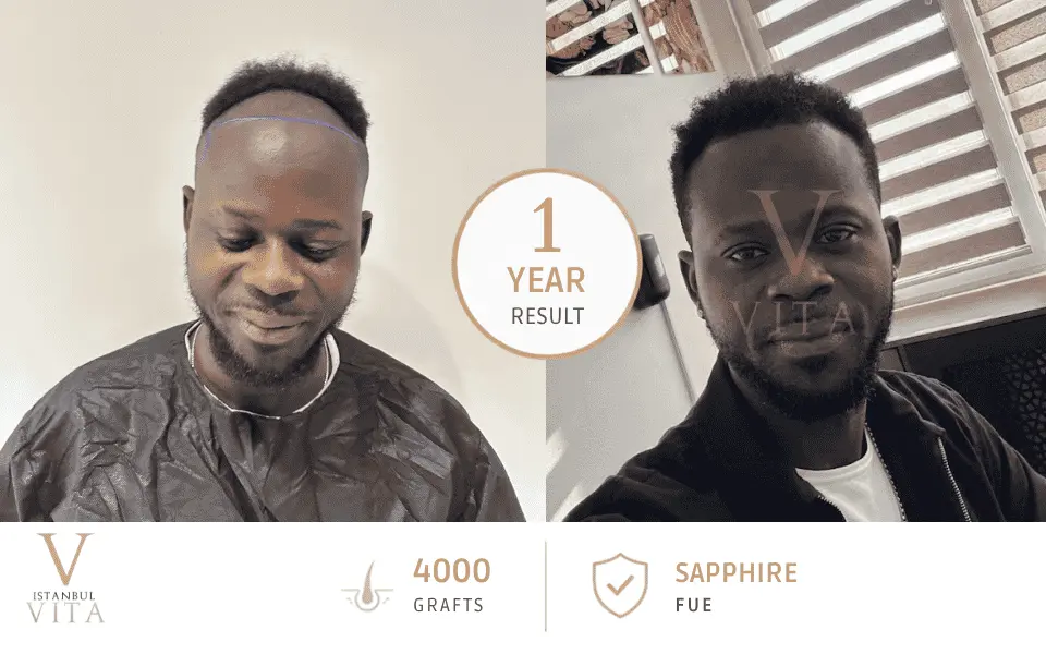 FUE Afro Hair Transplant