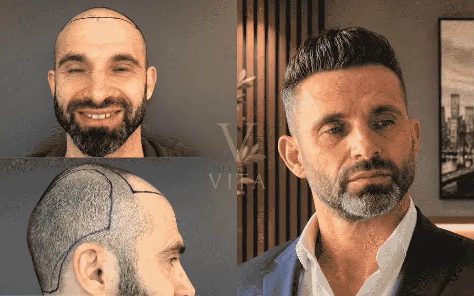 a person having before and after pic of his hair transplant