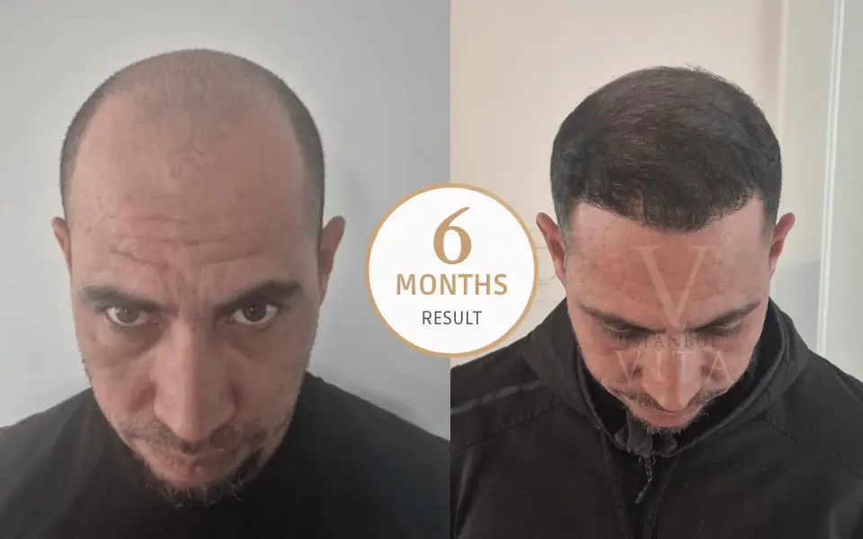 a person with the visible result of 6 month hair transplant 